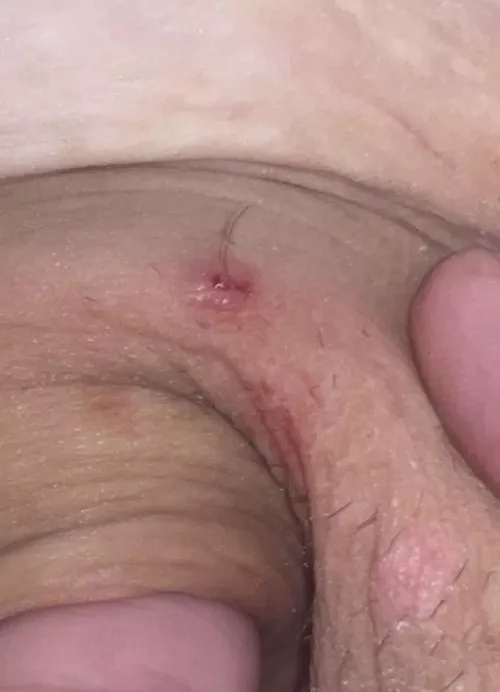 My gf has the clearest skin ever, so this ingrown that she let me get today was a nice surprise (armpit)