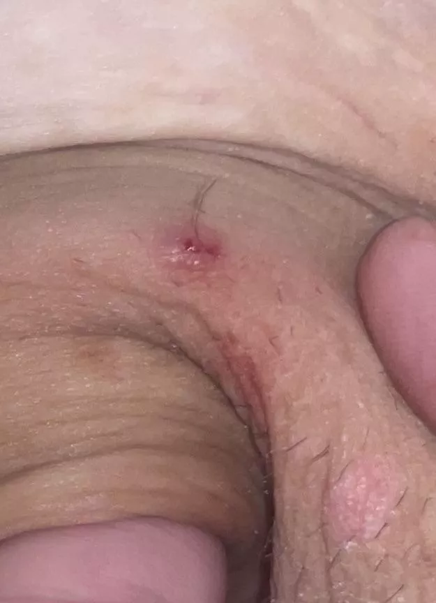 My gf has the clearest skin ever, so this ingrown that she let me get today was a nice surprise (armpit)