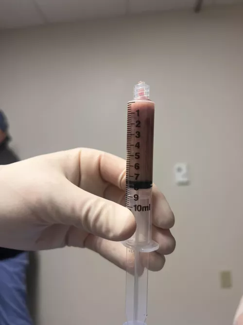 Had an abscess inside my breast, look what came out