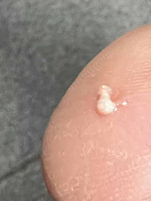 Popped this out of the nether region. Didn't see the pop since I couldn't see the area. Didn't even know I had it. Squeezed it a few more times to see if everything came out, only thing left was some blood.