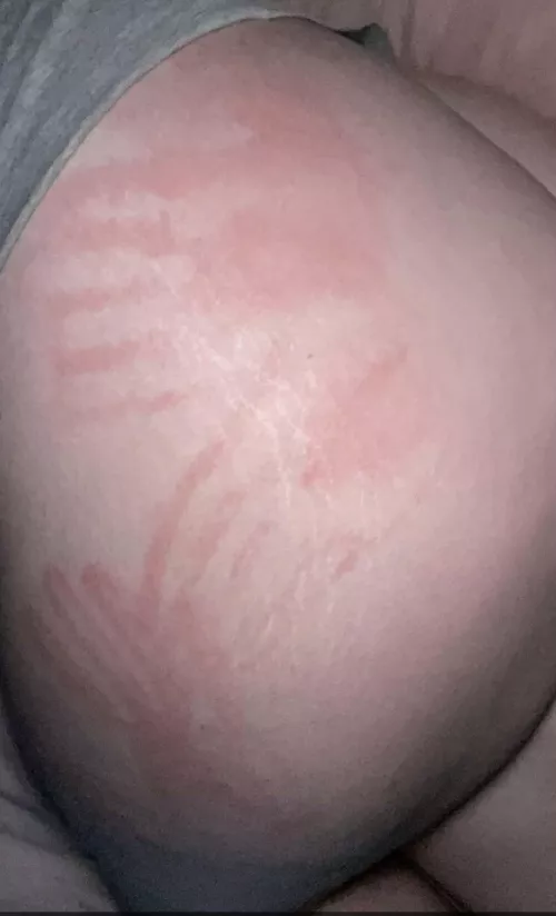 Probably gonna bruise 😬