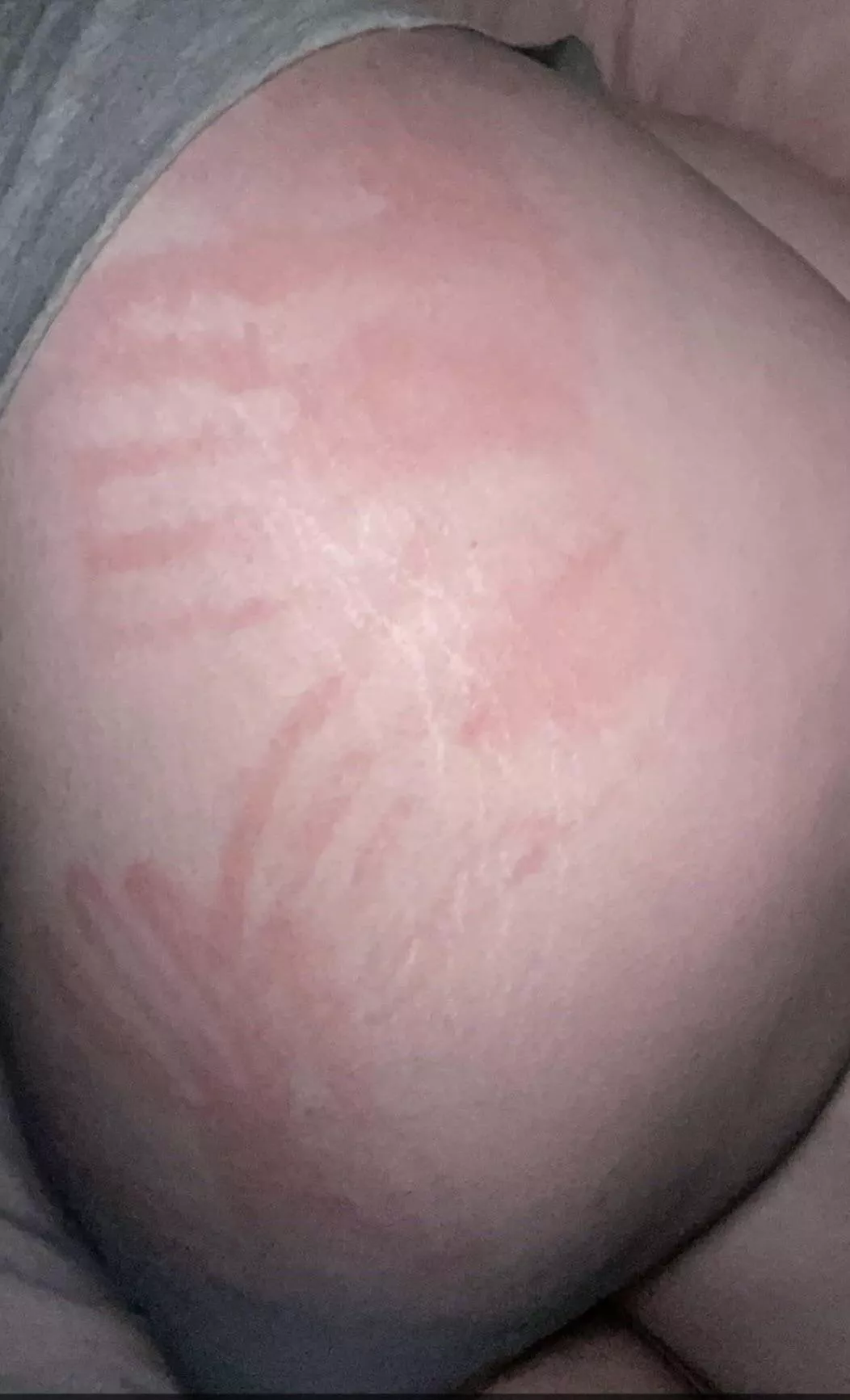 Probably gonna bruise 😬