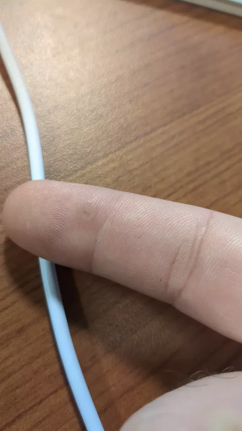 Is this a pimple of some sort?
