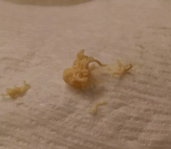 The most junk I have ever gotten from a single squeeze. My cyst (cheek) has since been removed.