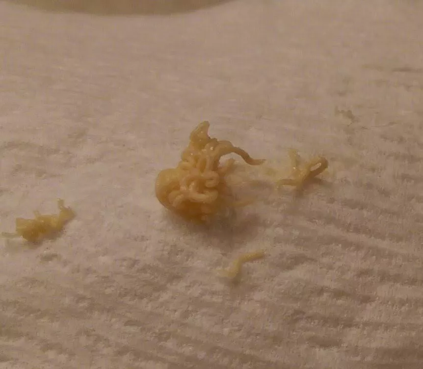 The most junk I have ever gotten from a single squeeze. My cyst (cheek) has since been removed.