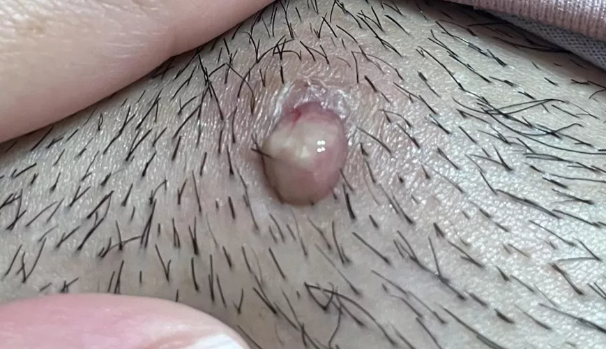 ingrown hair that finally came out when i popped it.