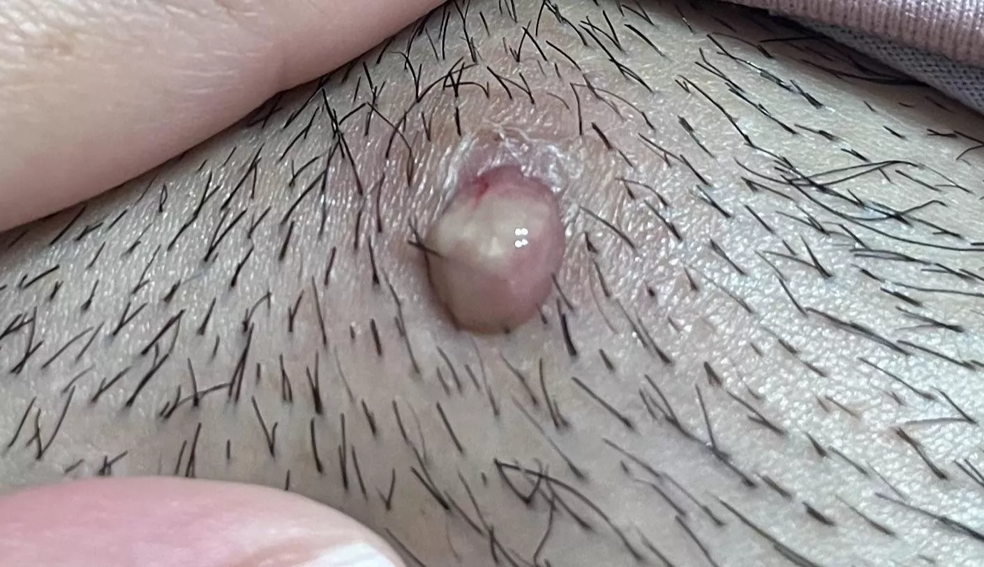 ingrown hair that finally came out when i popped it.