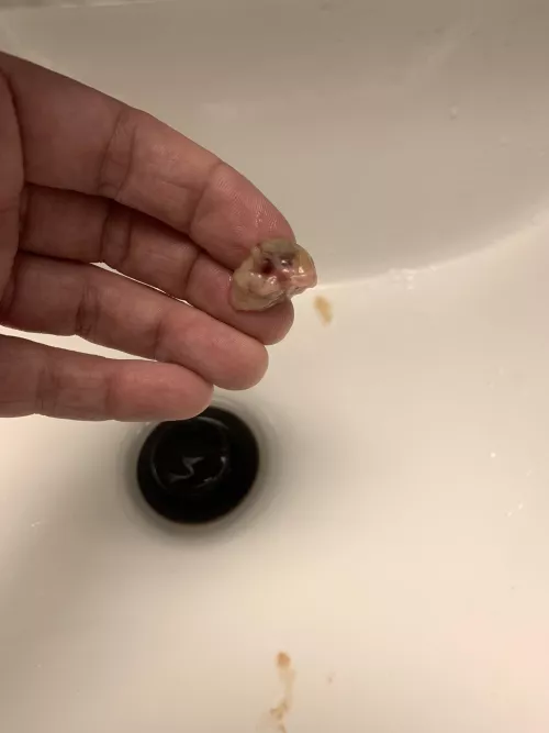 Was sick for a week 5 days of the worst sinusitis I’ve ever had. Coughed this up after nearly choking on it and came to post