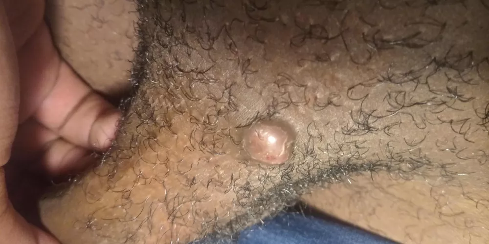 Anyone know what this is? Have had it for a month thought it would go but its still here should i pop it or visit a doctor?Did some research and its sayin its a cyst(Its also on my dick so it looks hella skechy)