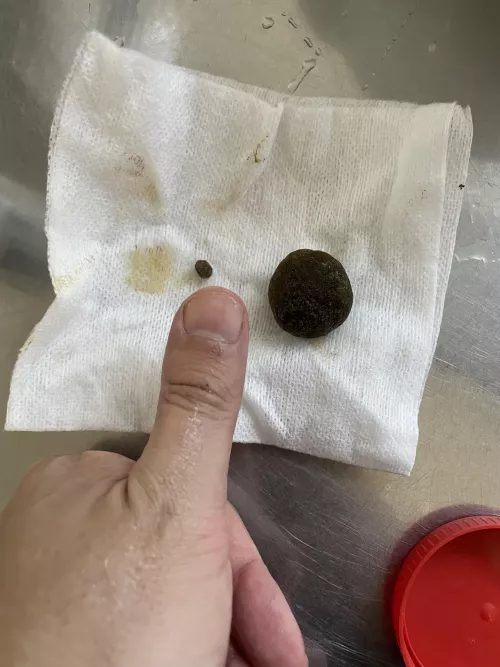 I couldn’t get video of this one, since it was major surgery under anaesthesia, so here’s a gallery stone. 0/10 experience. Worst pain of my life and I’ve had an organ explode inside me.