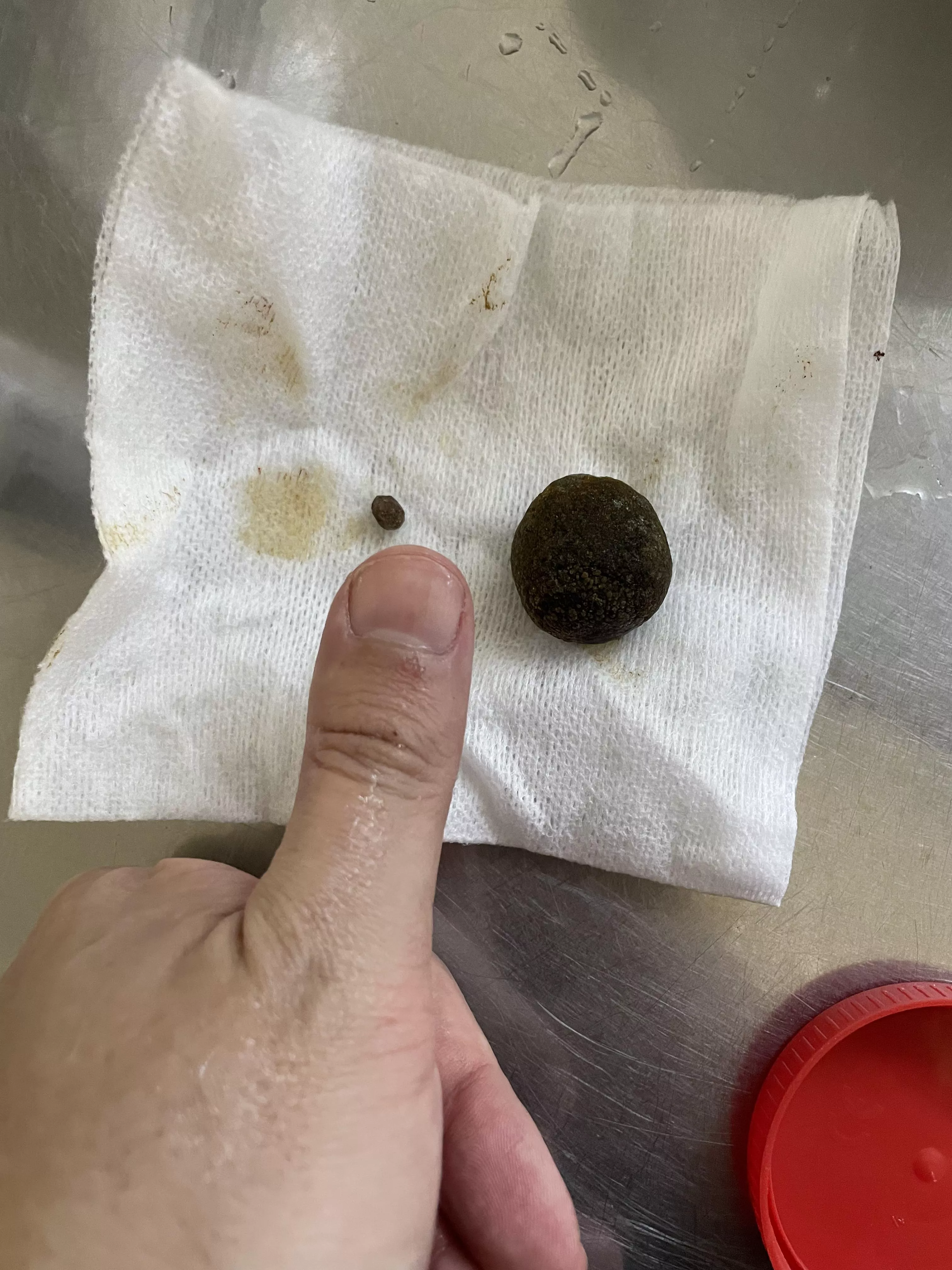 I couldn’t get video of this one, since it was major surgery under anaesthesia, so here’s a gallery stone. 0/10 experience. Worst pain of my life and I’ve had an organ explode inside me.