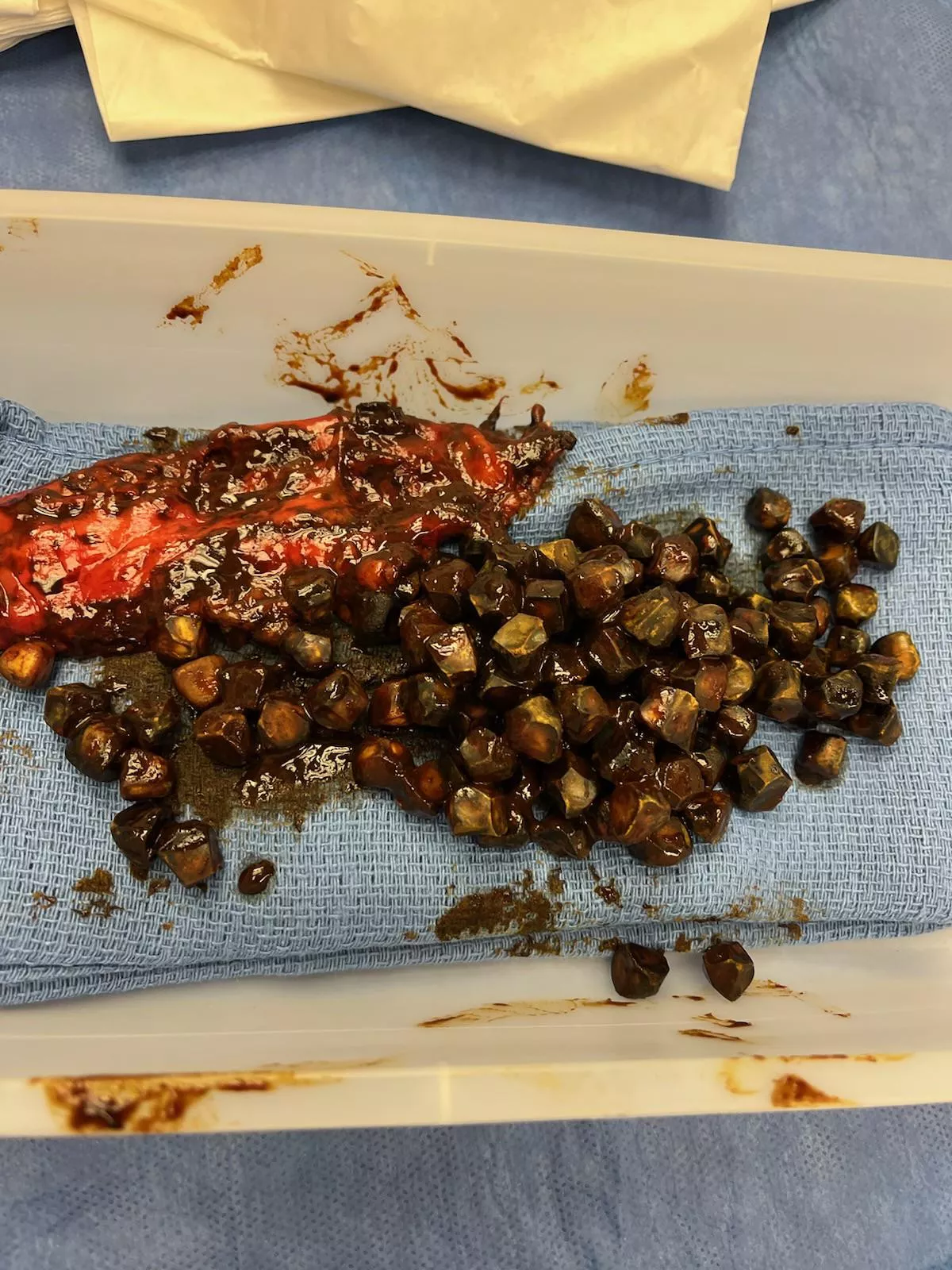 My dad had 117 gallstones removed the other day.