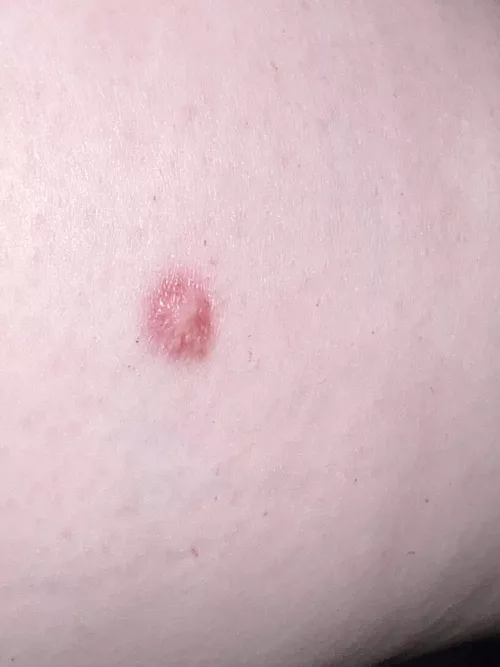 very old arm scar/lump