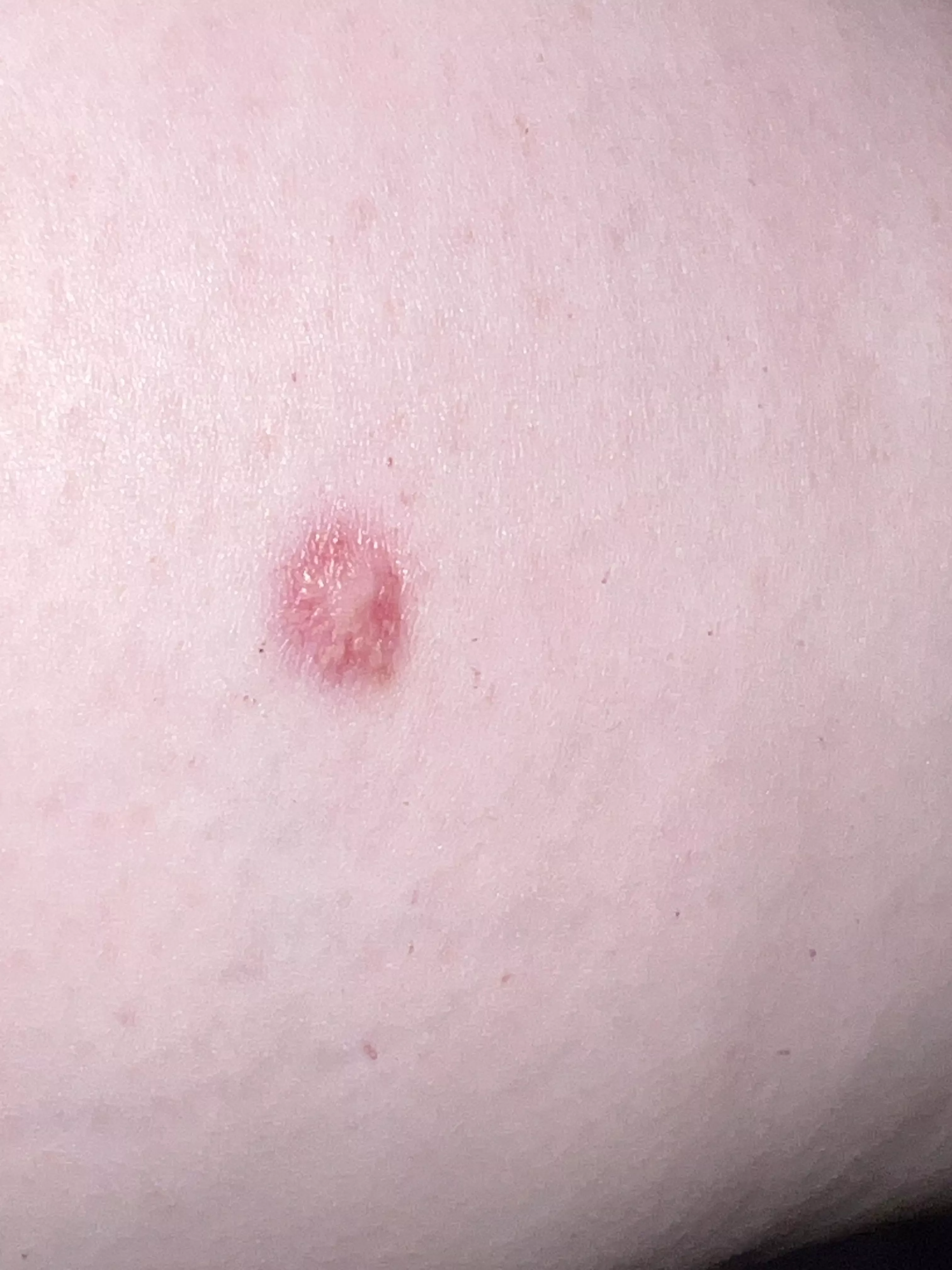 very old arm scar/lump