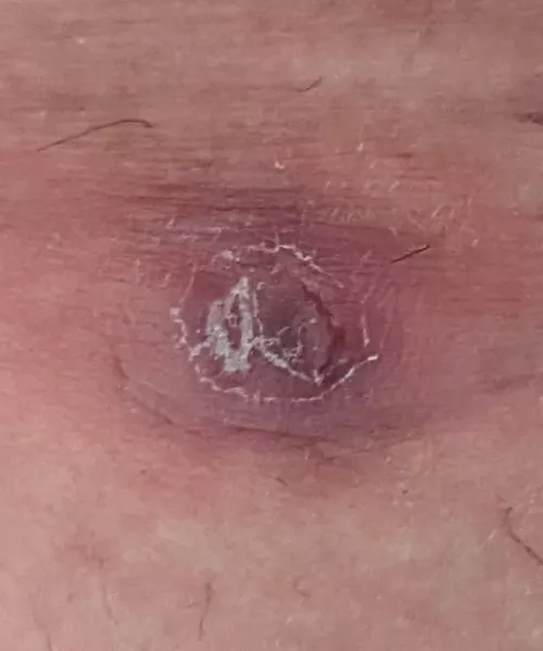 I get these painful bumps on my inner thigh. I'll try to get a pop on video, but they usually explode blood.