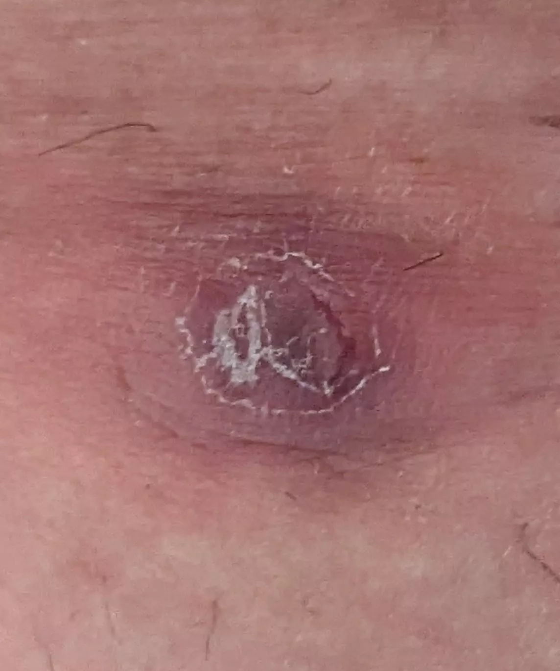 I get these painful bumps on my inner thigh. I'll try to get a pop on video, but they usually explode blood.