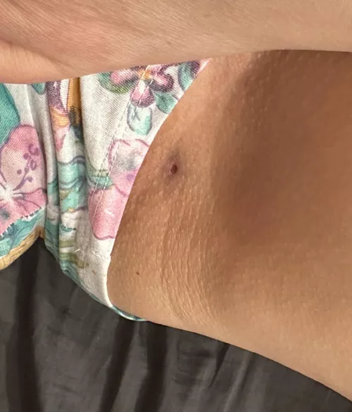 Is this a sinus or will it heal?