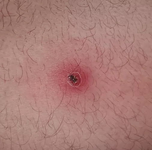 On my leg and hurts like hell, is it a boil?