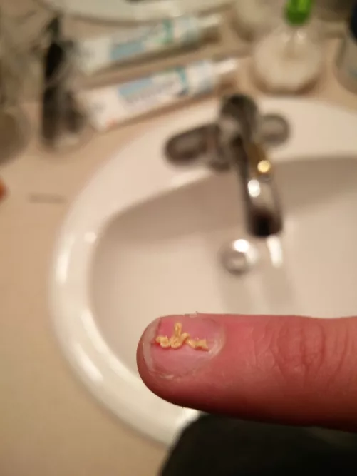 That feeling of popping a cyst that's been around for a while.