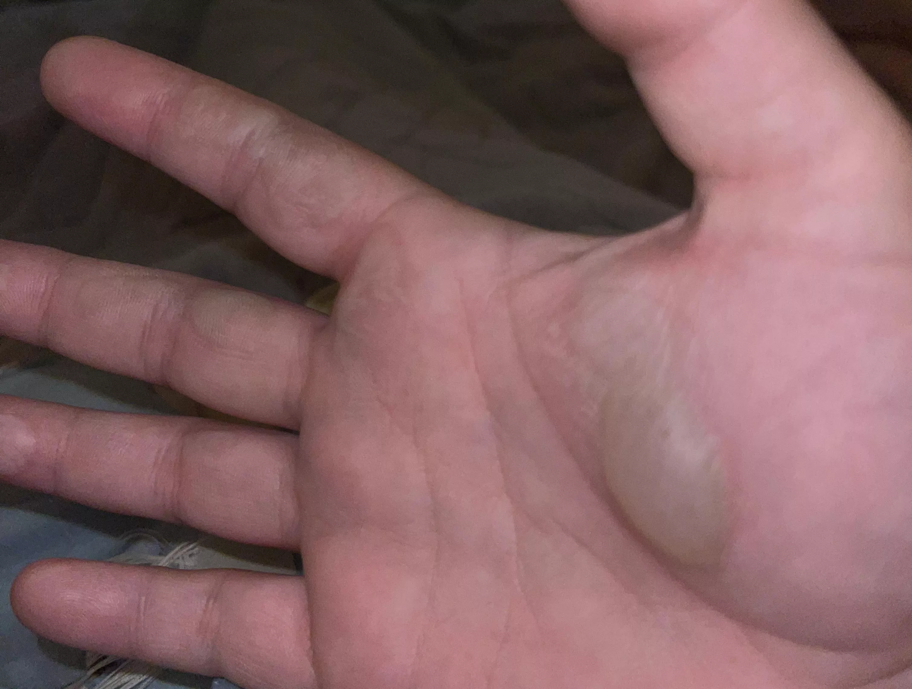 I burnt myself on a pan fresh out of the oven