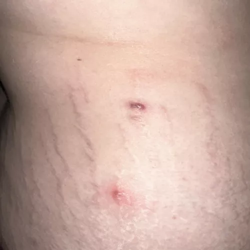 Abcess, boil or cyst?