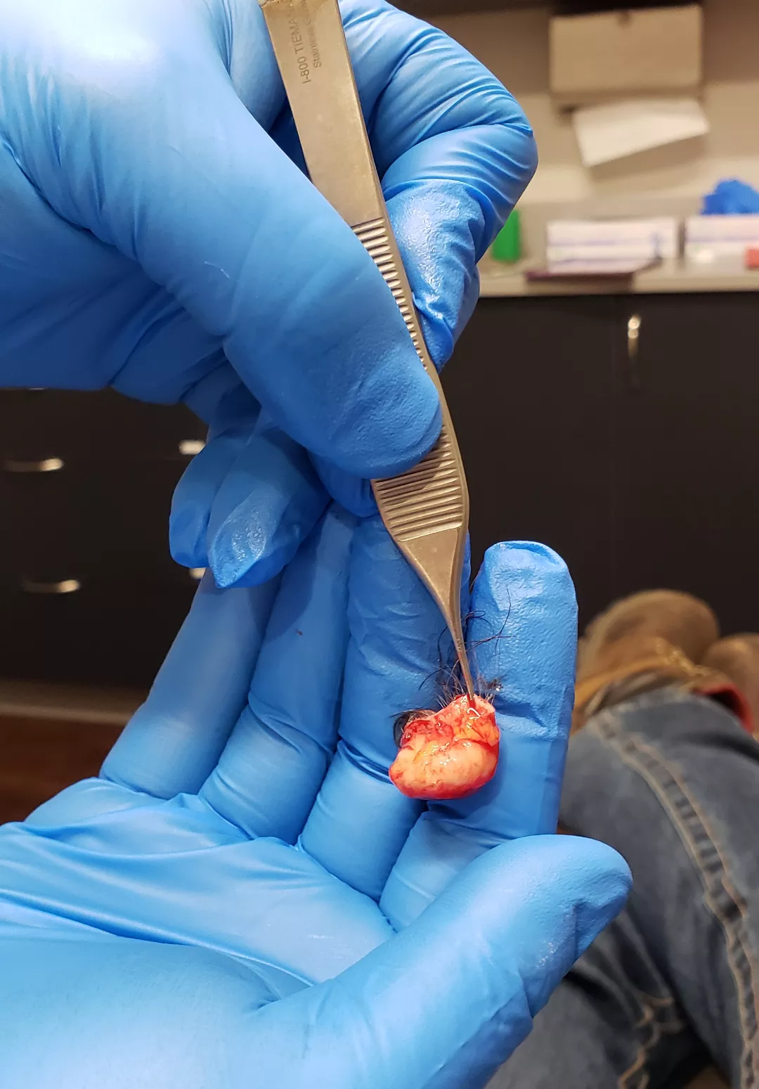 Had my 1.5 cm pilar cyst removed after 3± years