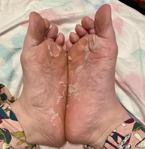 I used a foot peel mask