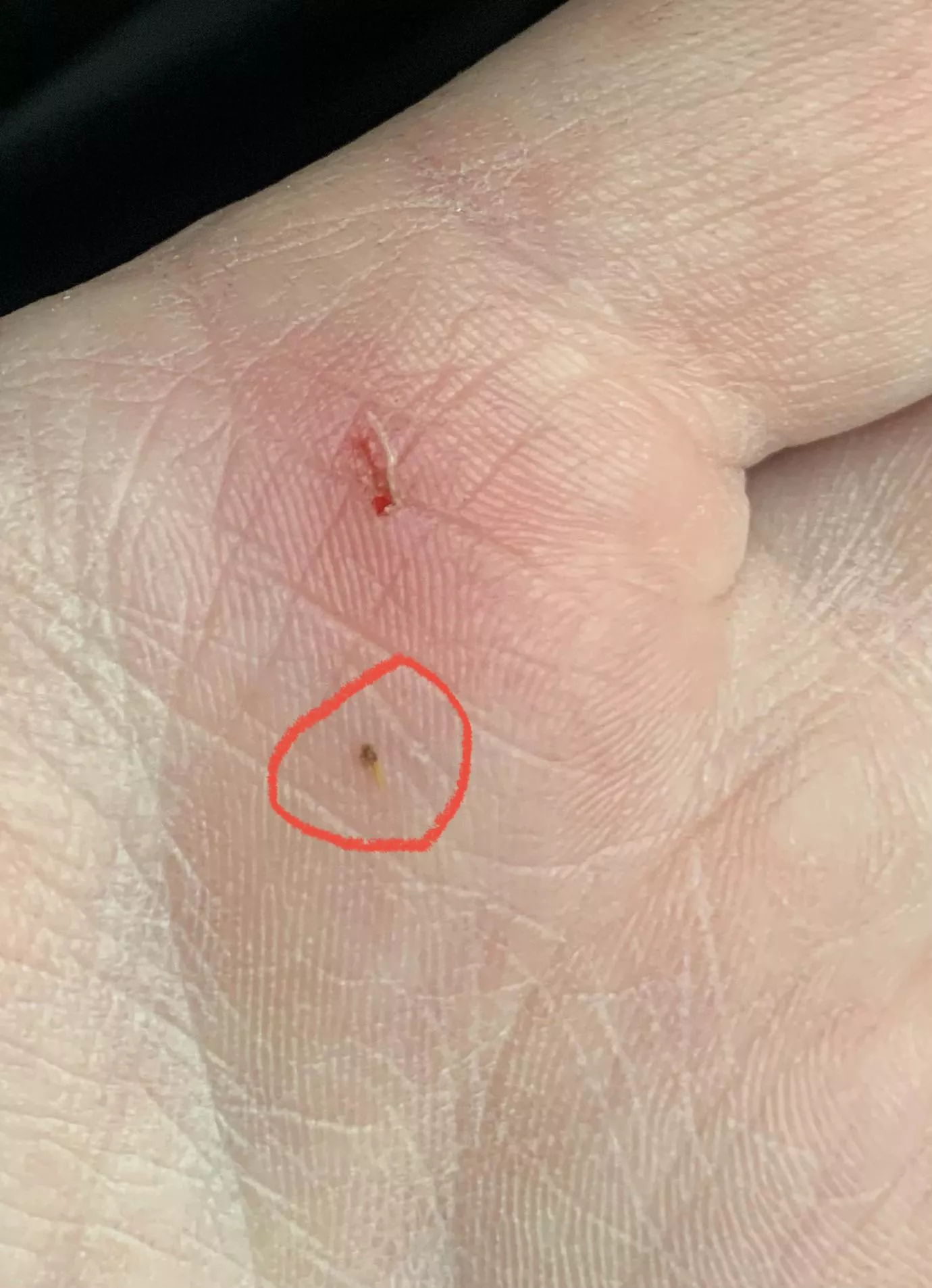 Tiniest splinter I’ve ever had! TLDR in comments :)