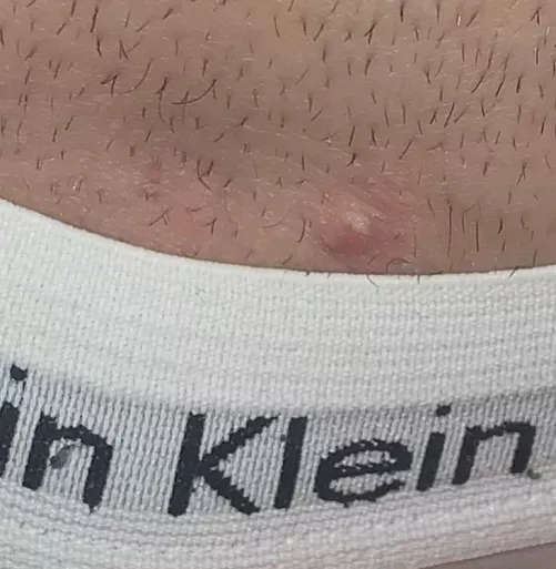 is this an ingrown hair/cyst? on pubic area
