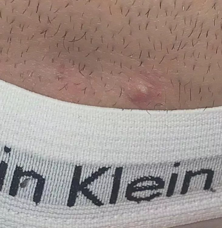 is this an ingrown hair/cyst? on pubic area