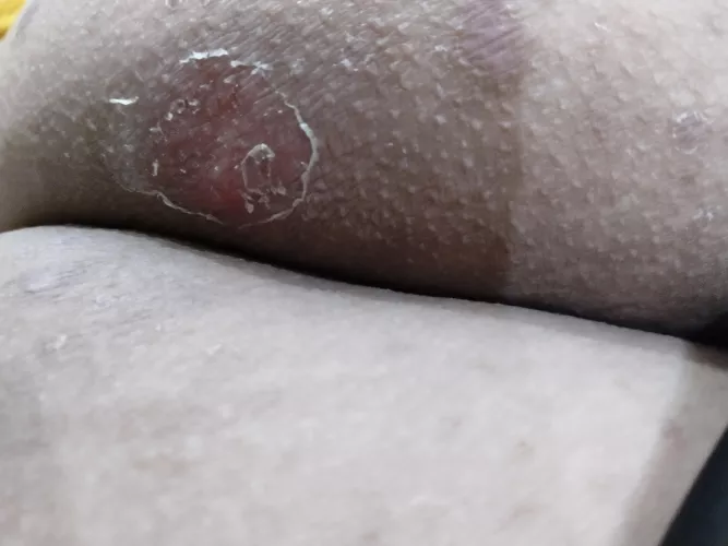 Cellulitis on my buttocks after 4 days of antibiotics