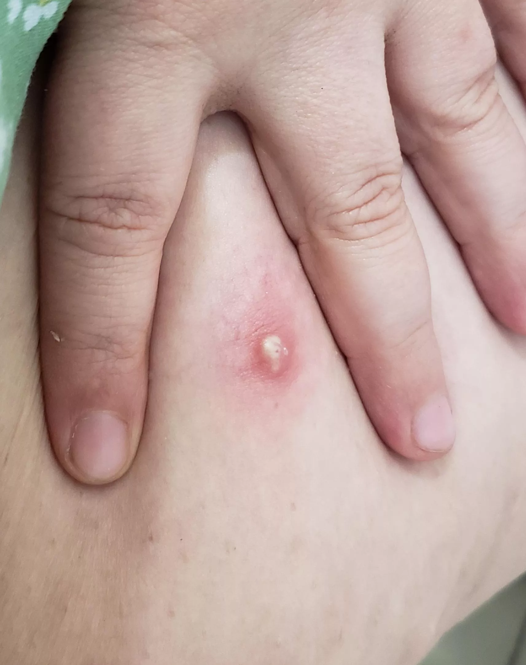 The doctor says to leave it and not to pop it...