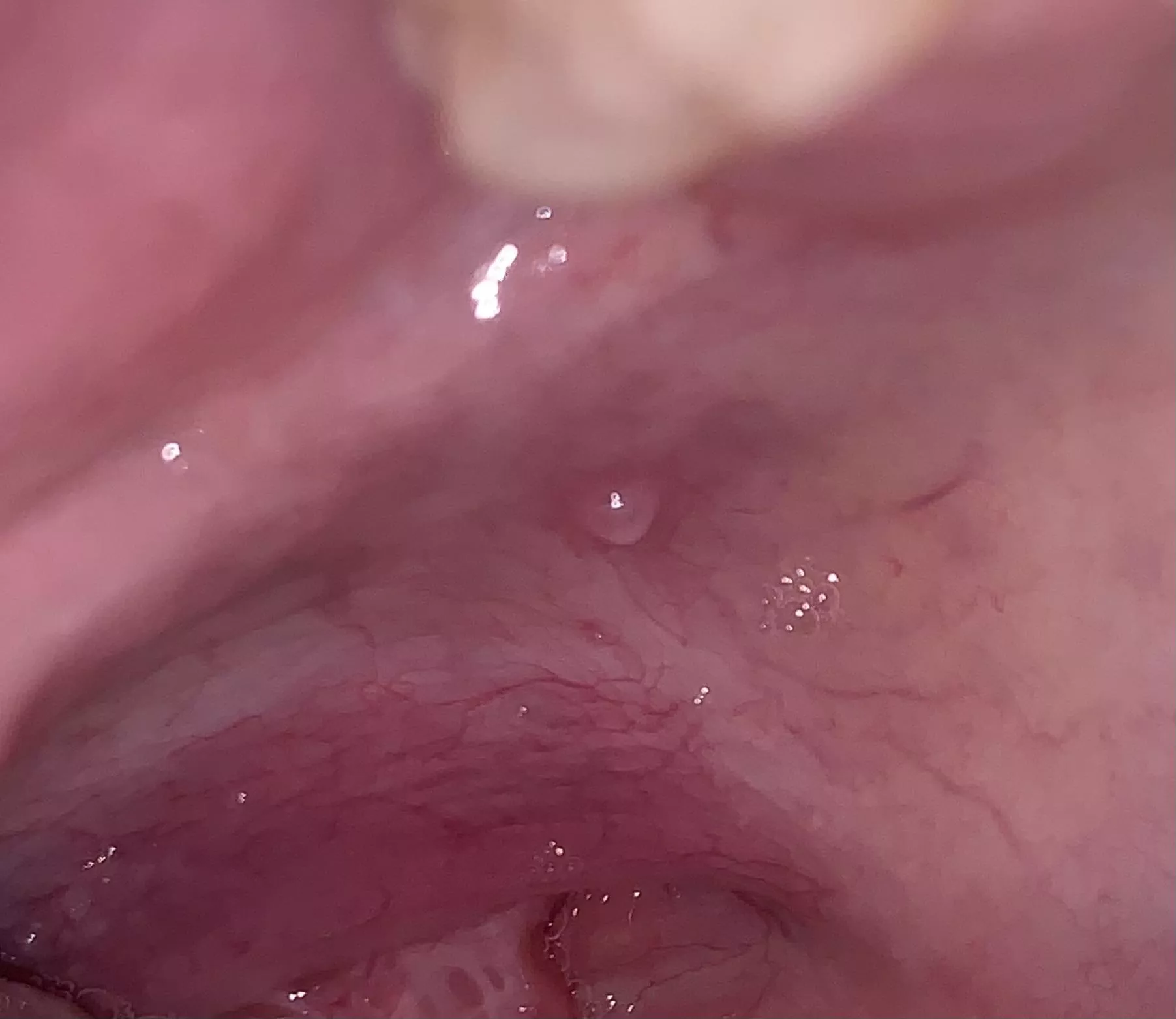 mucocele on the roof of my mouth (forbidden pop)