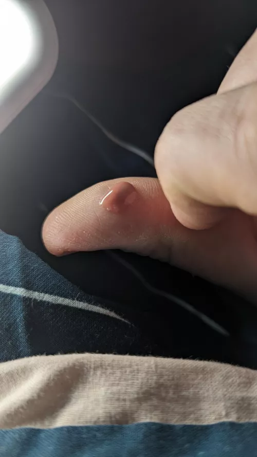 My armpit felt so much better after this mess came out.