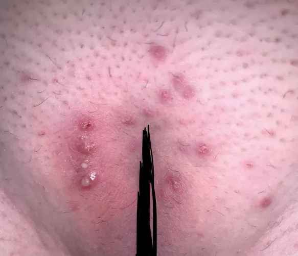 Part two of my first Brazilian after a long warm shower