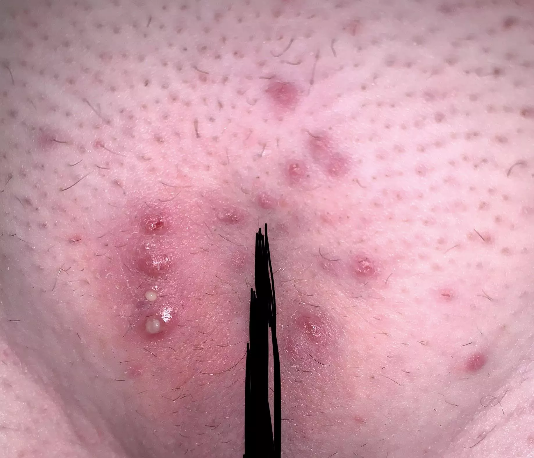 Part two of my first Brazilian after a long warm shower