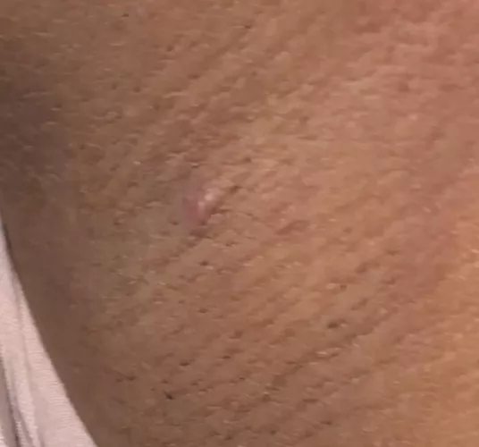 small red bump painful
