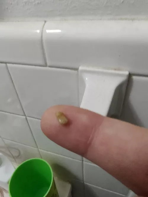 Woke up coughing up this bad boy