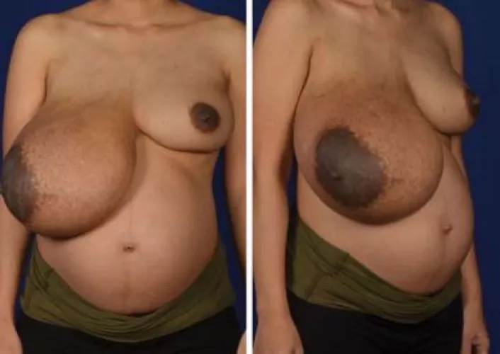 Extremely lopsided pregnant breasts