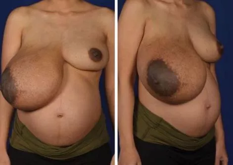 Extremely lopsided pregnant breasts