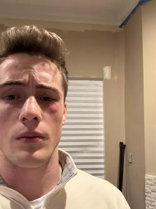 Got staph from wrestling practice so no date for me on Valentine’s Day😂