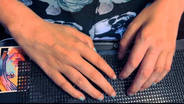 Quadriplegic curled hands. Video available…