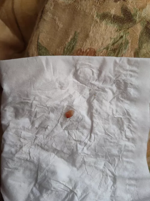 A rather odd cyst core.