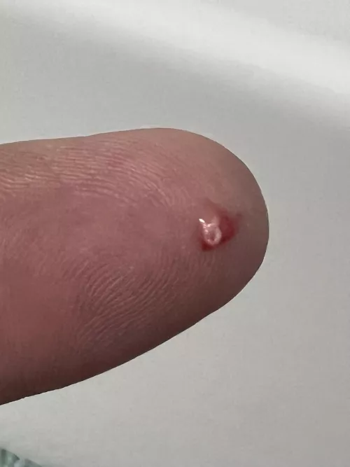 Had been brewing on my hip for a couple days. Once I popped it, all better now.