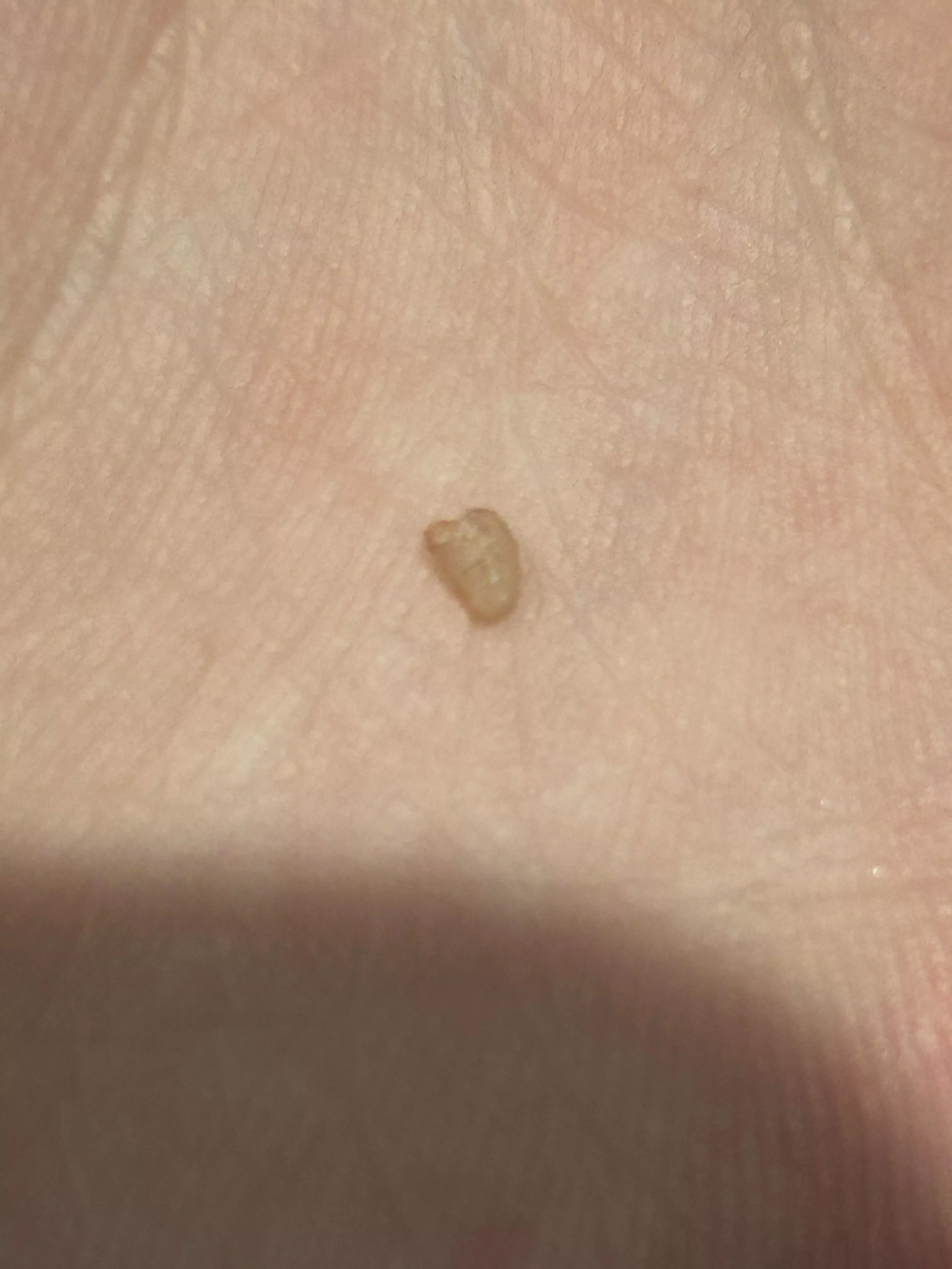 I popped and pulled this out of what started as an ingrown hair on my private part… any idea what it is? A cyst? 