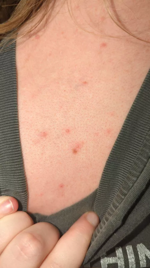 Little whiteheads on boyfriend's back 