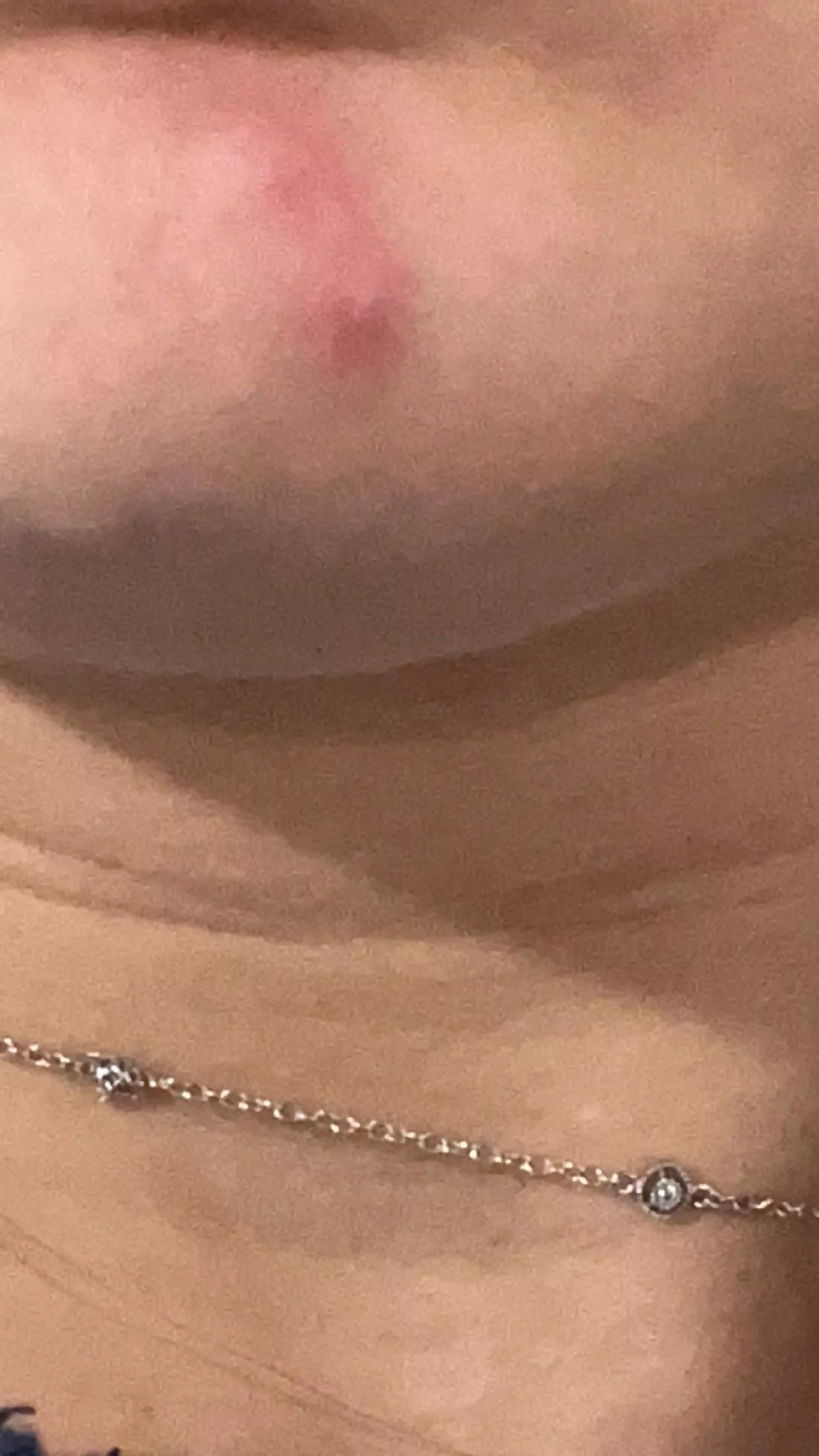 i have a double pimple????