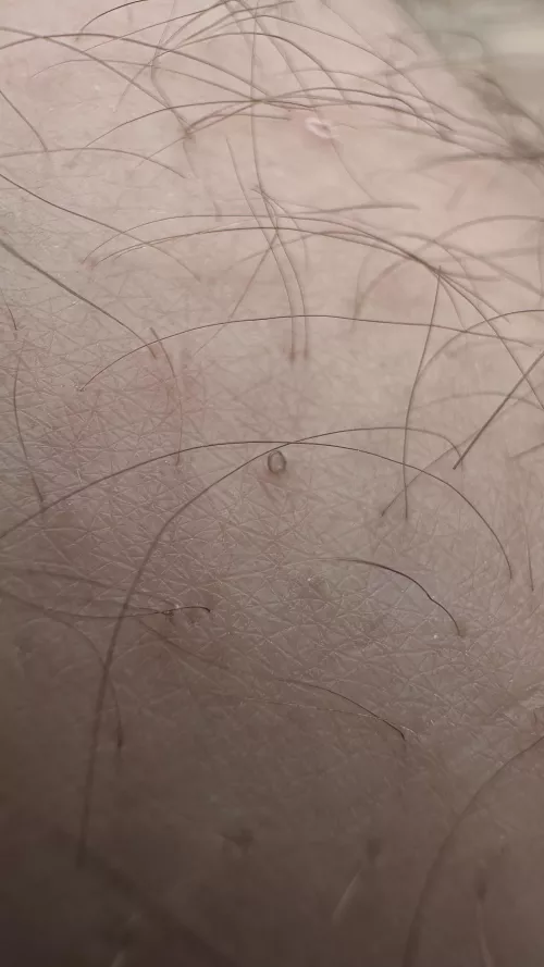 My husband gets what we call “uzumakis”