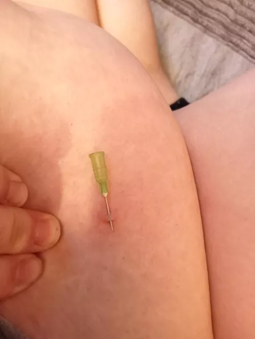 Oooh a tunnel. Reoccurring blackhead