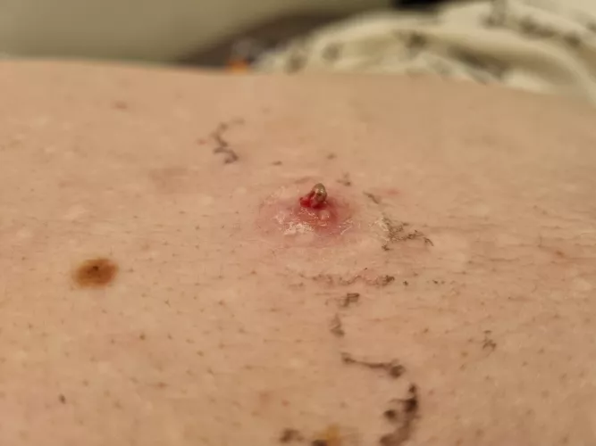 Old picture of a large, red thing brewing up. It popped on it's own under a bandaid and needed only a gentle push to get this hard nugget out of it. Instant relief.